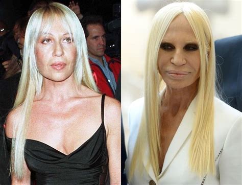 versace sister plastic surgery.